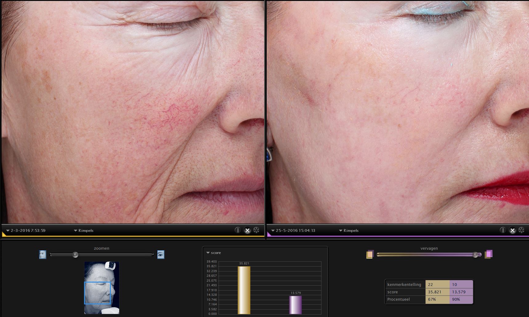 drstevens.nl 2DDdubbel huidwkaliteit TCA lipofilling PRP VISIA fotografie