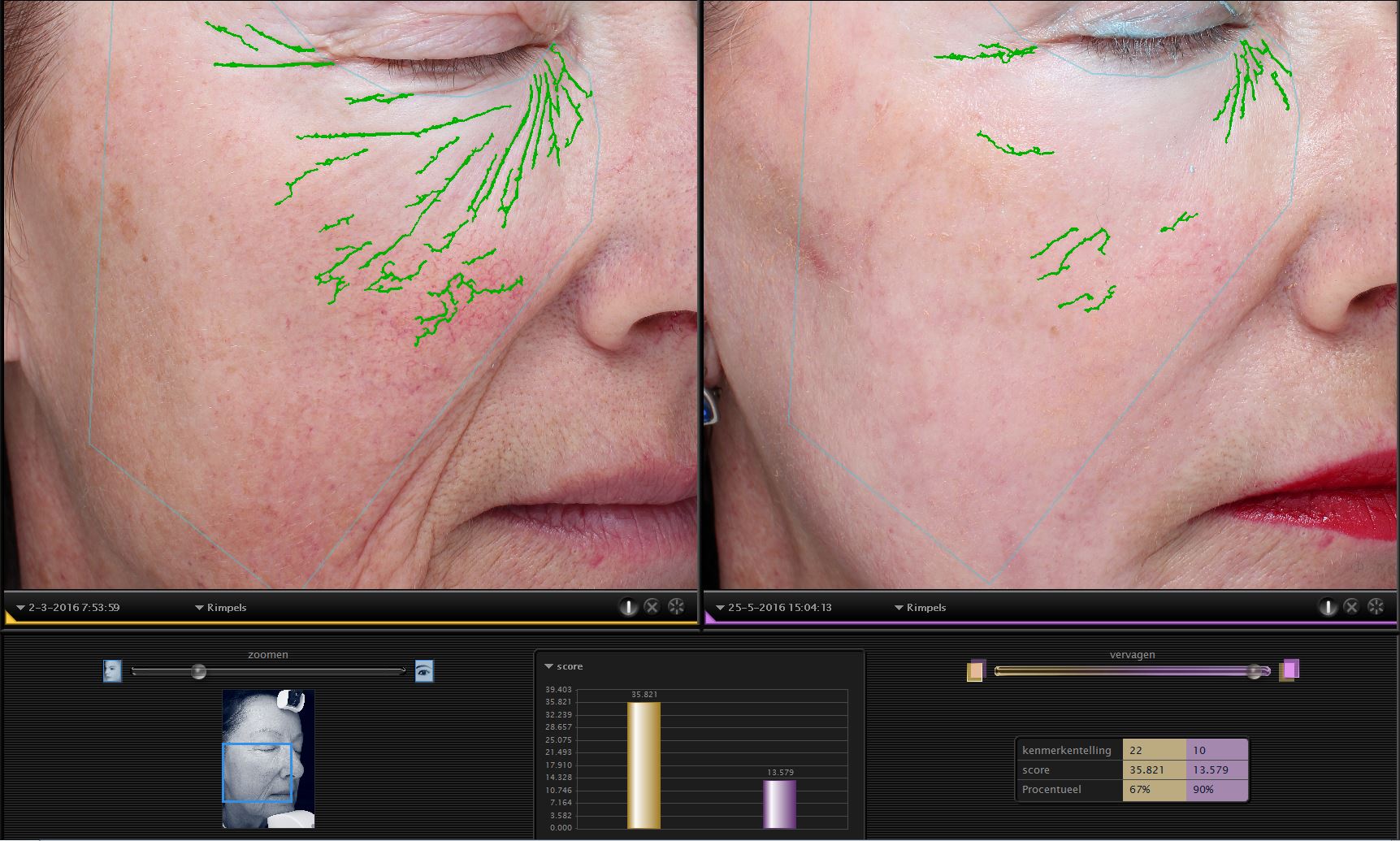 drstevens.nl 2DDdubbel huidwkaliteit TCA lipofilling PRP VISIA fotografie