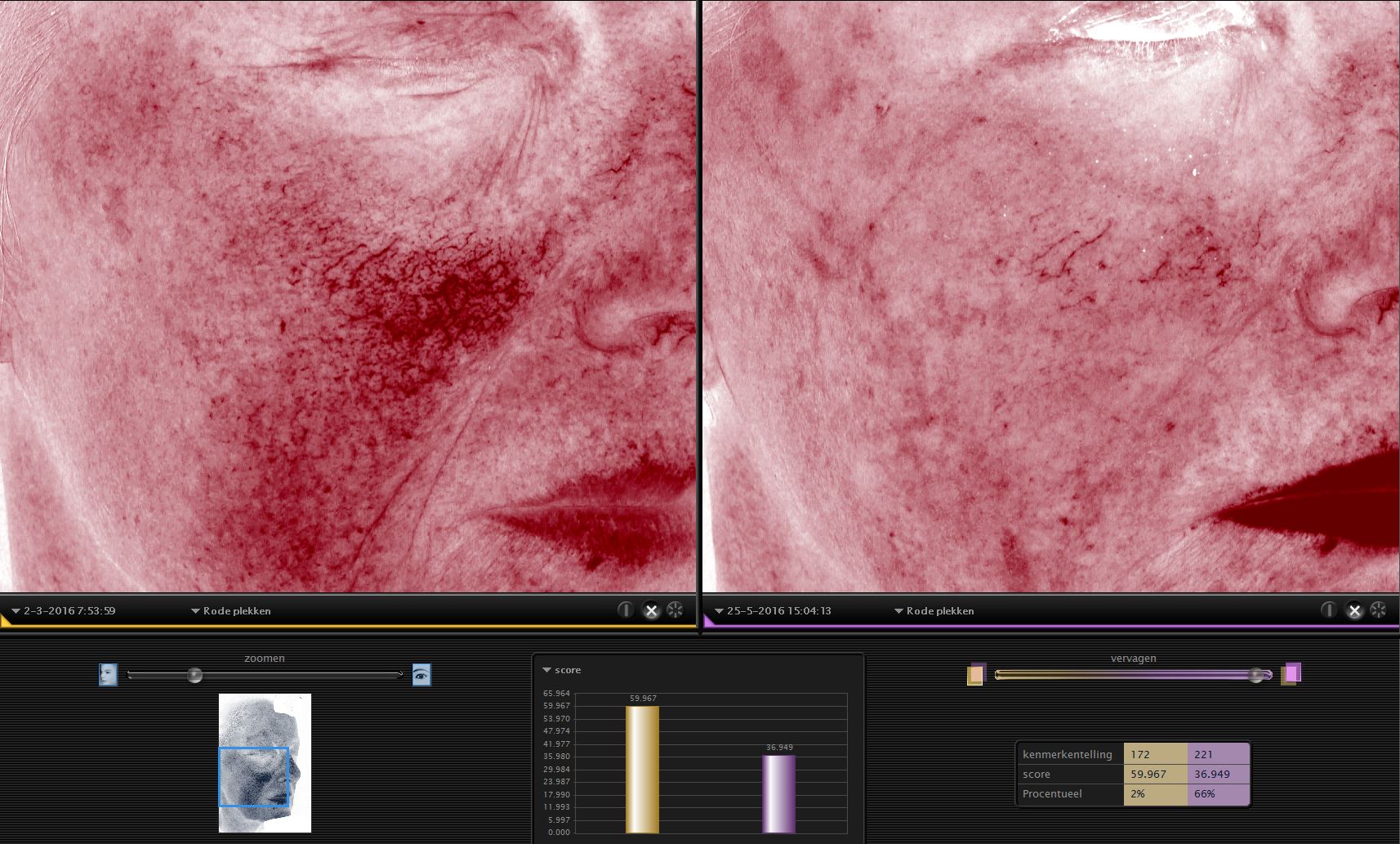 drstevens.nl 2DDdubbel huidwkaliteit TCA lipofilling PRP VISIA fotografie