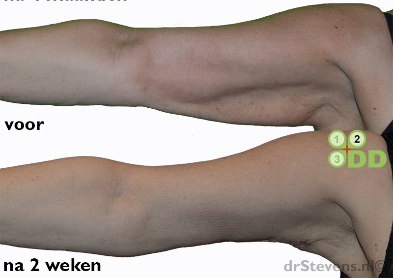Armlift via lipofilling en TCA peeling - drStevens.nl