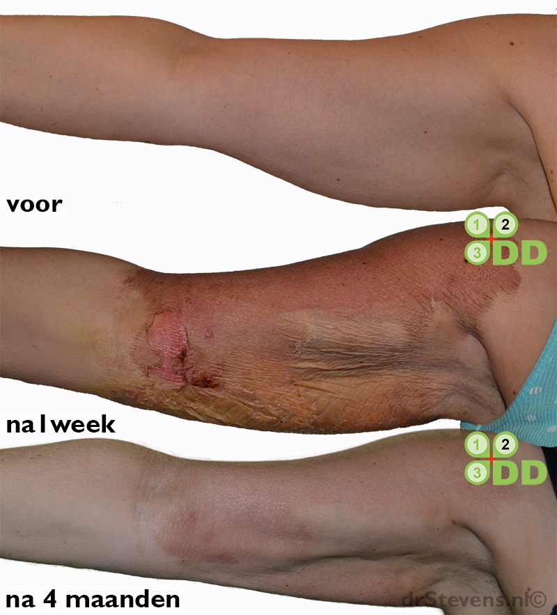 Armlift via lipofilling en TCA peeling - drStevens.nl