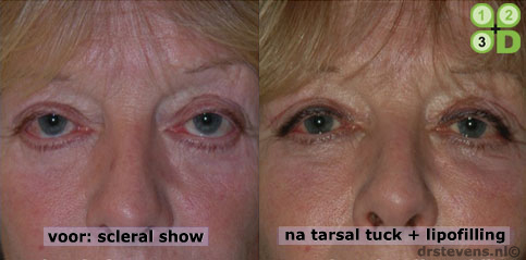 lipofilling tarsal-tuck aangezicht vrouw - drstevens.nl