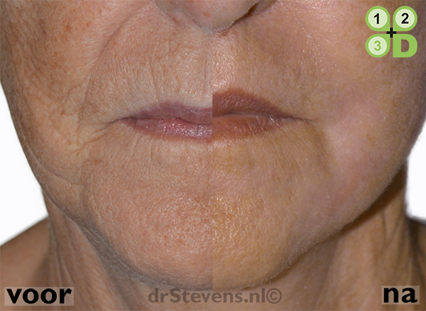 2d rimpels aangezicht vrouw - drstevens.nl