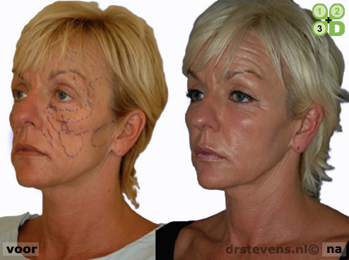 3d uitstraling aangezicht vrouw - drstevens.nl
