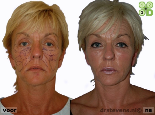 3d uitstraling aangezicht vrouw - drstevens.nl