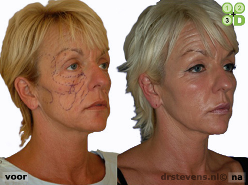 3d uitstraling aangezicht vrouw - drstevens.nl
