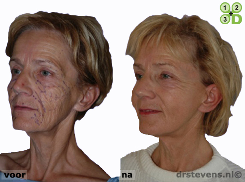 3d uitstraling hang-gezicht aangezicht vrouw - drstevens.nl