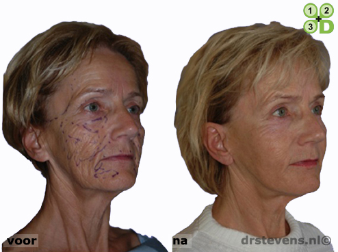 3d uitstraling hang-gezicht aangezicht vrouw - drstevens.nl