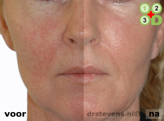 bio-chirurgie aangezicht vrouw - drstevens.nl