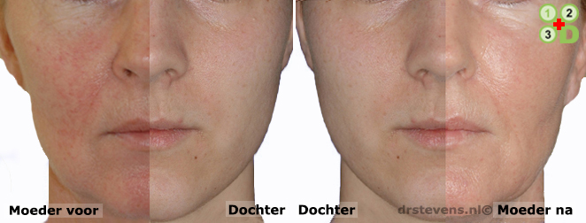 bio-chirurgie aangezicht vrouw - drstevens.nl