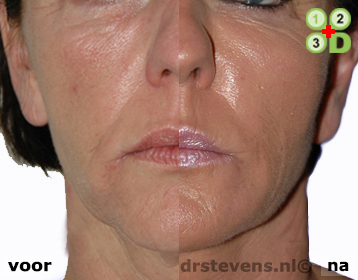 bio-chirurgie groeifactoren lipofilling aangezicht vrouw - drstevens.nl