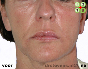 bio-chirurgie groeifactoren lipofilling aangezicht vrouw - drstevens.nl