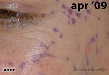 bio-chirurgie kraaienpootjes vrouw - drstevens.nl