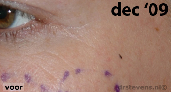 bio-chirurgie kraaienpootjes vrouw - drstevens.nl