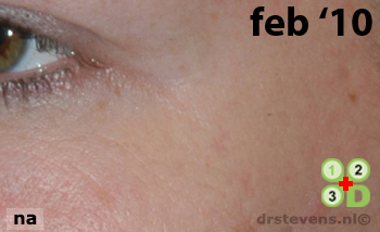 bio-chirurgie kraaienpootjes vrouw - drstevens.nl