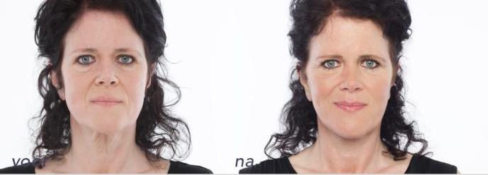 hals-facelift halslift 123dimensionaal kaaklijn aangezicht vrouw - drstevens.nl
