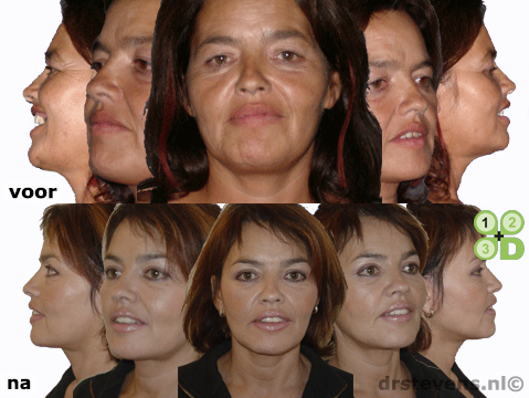 macs-lift ooglidcorrectie endoscopische-voorhoofdslift aangezicht vrouw - drstevens.nl