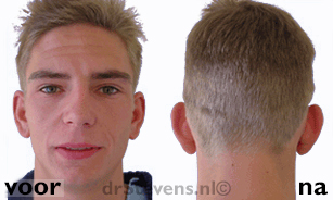 oorcorrectie aangezicht man - drstevens.nl