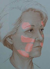illustratie techniek correctie aptos-lift aangezicht - drstevens.nl