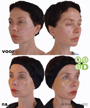aptos-lift aangezicht vrouw - drstevens.nl