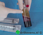 operatietechniek plasma witte-bloedcellen bio-chirurgie aangezicht - drstevens.nl