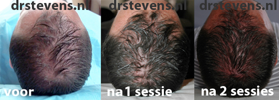 bio-chirurgie aangezicht man - drstevens.nl