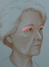 illustratie techniek correctie bovenoogleden aangezicht - drstevens.nl