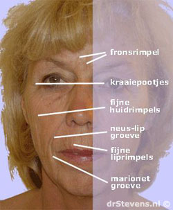 rimpels gezicht vrouw - drstevens.nl