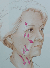 illustratie operatietechniek oud correctie uitstraling halslift hals-facelift aangezicht - drstevens.nl