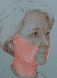 illustratie techniek correctie hals-facelift aangezicht - drstevens.nl