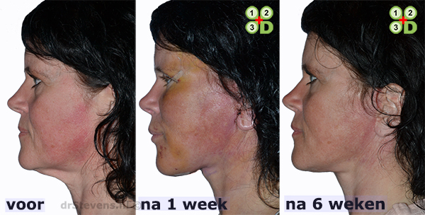 hals-facelift halslift 123dimensionaal kaaklijn aangezicht vrouw - drstevens.nl
