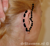 operatietechniek u-lift oor halslift hals-facelift aangezicht - drstevens.nl