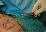 liposuctie bloedvaatjes vetcellen inbrengen operatietechniek - drstevens.nl