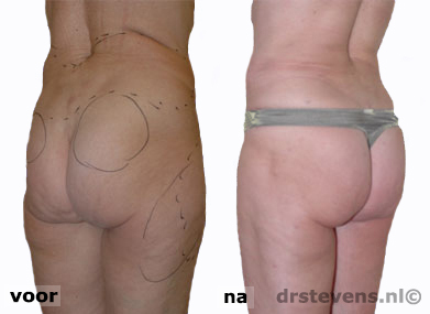 bilvergroting 180cc sculpturing vrouw - drstevens.nl