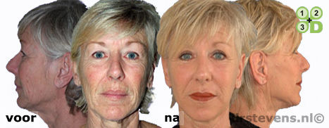 hals-facelift lipofilling uitstraling aangezicht vrouw - drstevens.nl