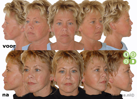 macs-lift bovenooglidcorrectie fronsrimpel aangezicht vrouw - drstevens.nl