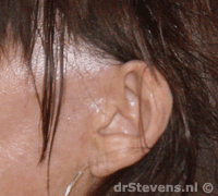 s-lift aangezicht vrouw - drstevens.nl