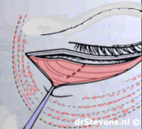 illustratie operatietechniek incisie wimperrand onderoogleden aangezicht - drstevens.nl