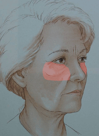 illustratie techniek correctie onderoogleden aangezicht - drstevens.nl