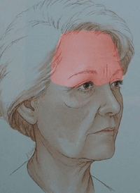 illustratie techniek correctie voorhoofd aangezicht - drstevens.nl