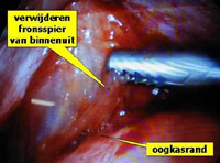 operatietechniek fronsspieren wenkbrauw oogkasrand voorhoofd aangezicht - drstevens.nl
