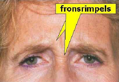 techniek correctie wenkbrauw fronsrimpels voorhoofd aangezicht - drstevens.nl