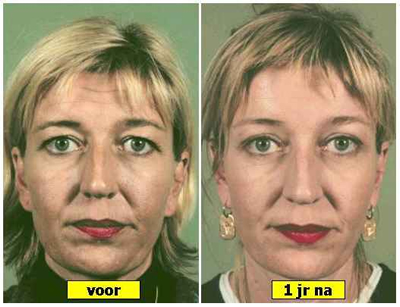 endoscopische-voorhoofdslift bovenooglidcorrectie aangezicht vrouw - drstevens.nl