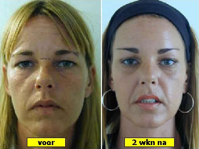 endoscopische-voorhoofdslift bovenooglidcorrectie frons aangezicht vrouw - drstevens.nl