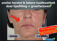 techniek bio-chirurgie lipofilling groeifactoren aangezicht - drstevens.nl