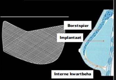 Inwendige kwartbeha in borst - drStevens.nl