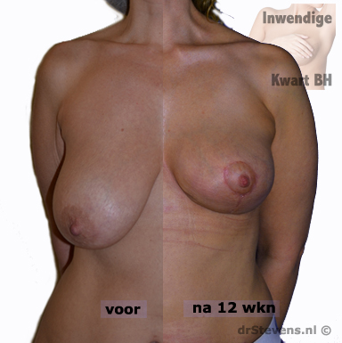 Voorbeeld inwendige kwart BH - drStevens.nl