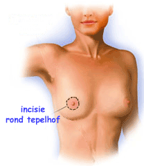illustratie techniek borsvergroting prothese incisie tepelhof - drstevens.nl