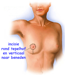 illustratie techniek borsvergroting prothese incisie tepelhof verticaal - drstevens.nl