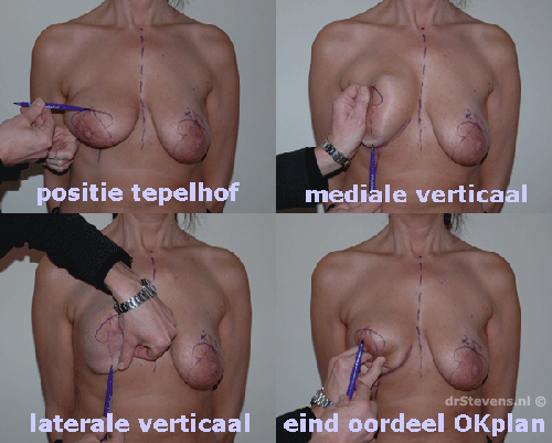 borstlift prothese 180cc vrouw - drstevens.nl